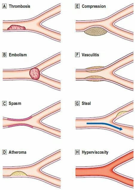 Illustration of vascular pathology. ⬇️
#MedTwitter #MedEd
