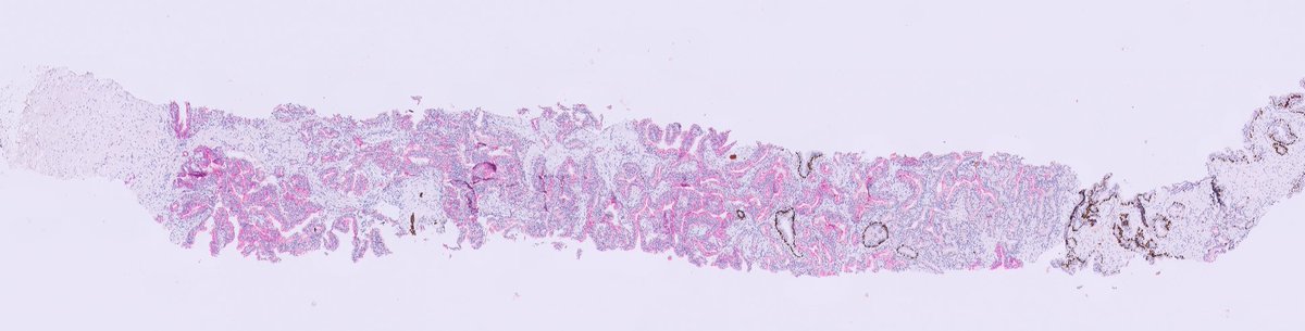 #yourdailygleasongrading reporting 😁 #GUpath colleagues how would you grade this prostate biopsy? The IHC is p63 (brown)- AMACR (red)👇 #pathtwitter