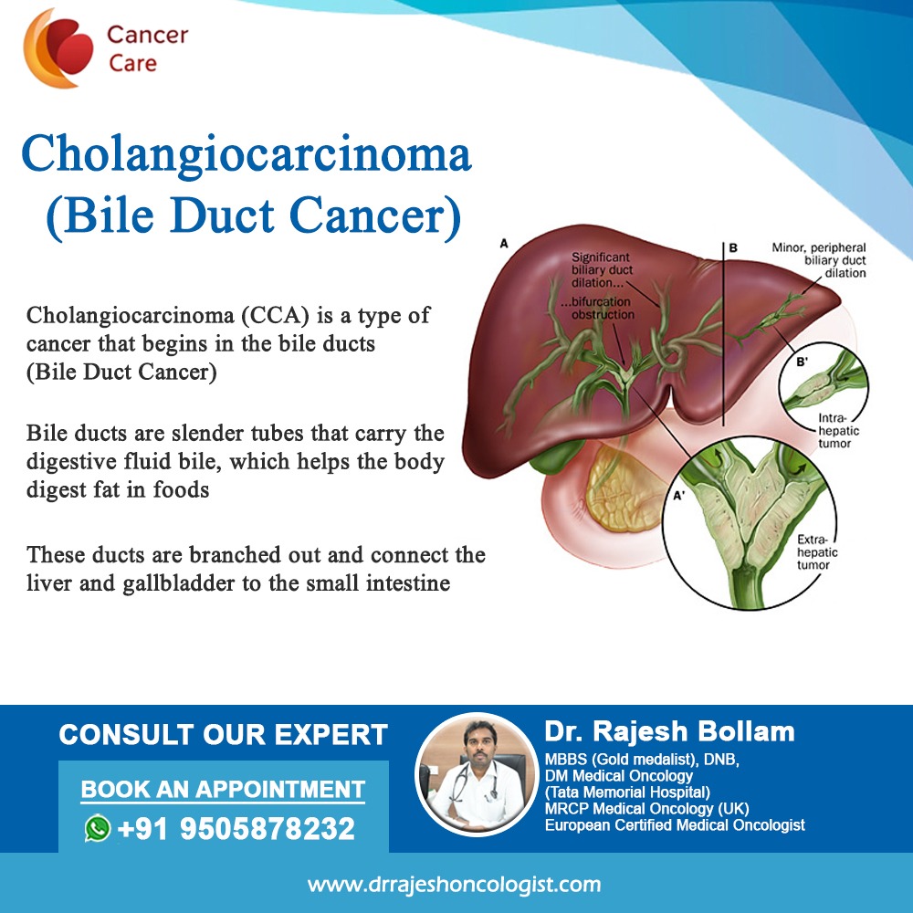 Cholangiocarcinoma, a bile duct cancer, is a rare but aggressive malignancy that originates in the ducts transporting bile from the liver to the small intestine. #Cholangiocarcinoma #BileDuctCancer #LiverHealth #CancerAwareness #RareDiseases