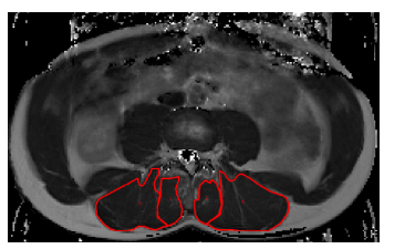 Higher back muscle metabolism seen on fMRI in those with CLBP with high intramuscular fat (IMF) content after an extensor exertion test.
i.e. IMF may lead to increased workload on the muscle which increases fatigue and reduces tissue PH
👉 implications for function and pain