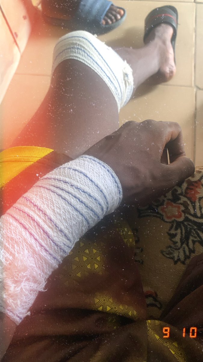 Have you ever had a dislocation before? 
How was your experience 🥲

First time having one and it came in doubles 😭😭