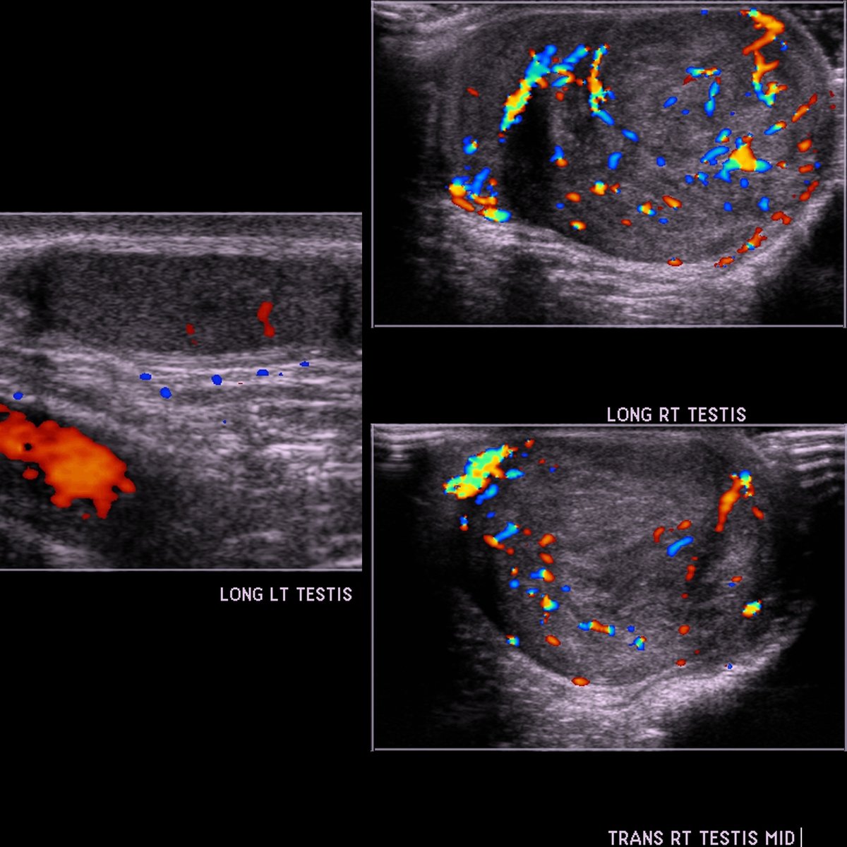 Preschooler with painless right scrotal mass for 1 month

Sagittal color doppler US of left scrotum(left) shows left testicle to be unremarkable. 

#FOAMed #MedEd #FOAMPed #FOAMRad #PedsRad #RadEd #RadRes #radiology #PedUro #PedOnc #FOAMus #USRad #Ultrasound #EmergencyMedicine