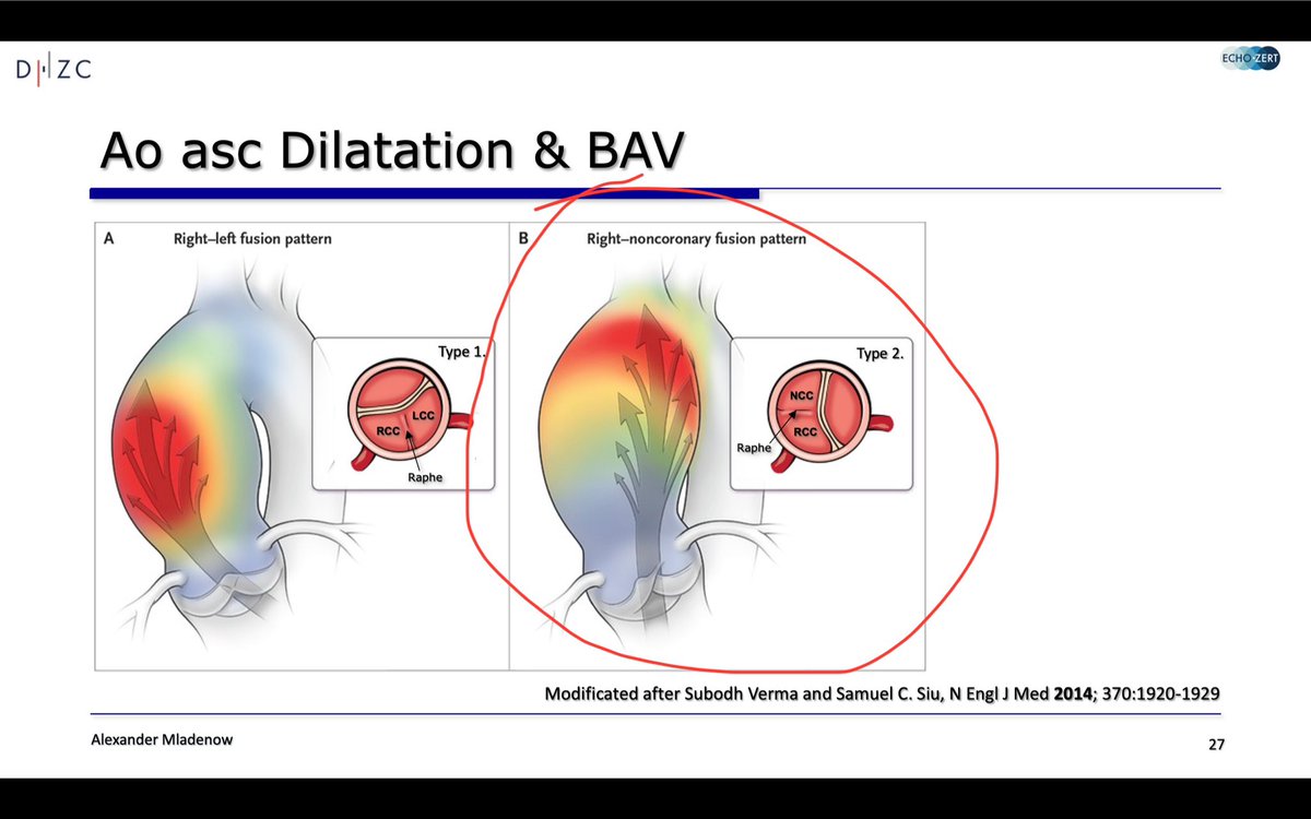 @Irina67790690 Fused BAV 👉 Right-Non Cusp fusion (20-30%) #echofirst #CardioTwitter @NMerke