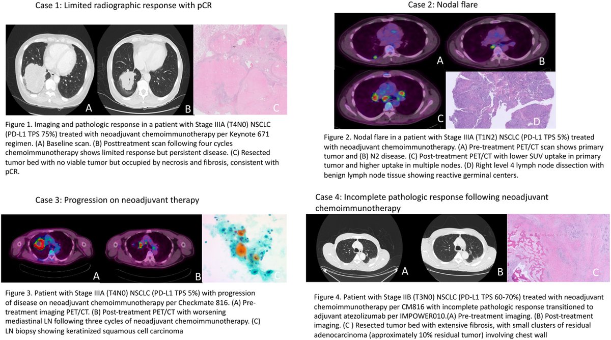 The treatment landscape of neoadjuvant/perioperative immunotherapy for NSCLC is rapidly evolving. Check out a review article that highlights key outcomes from major clinical trials and identifies current knowledge gaps. bit.ly/4dDOp3H