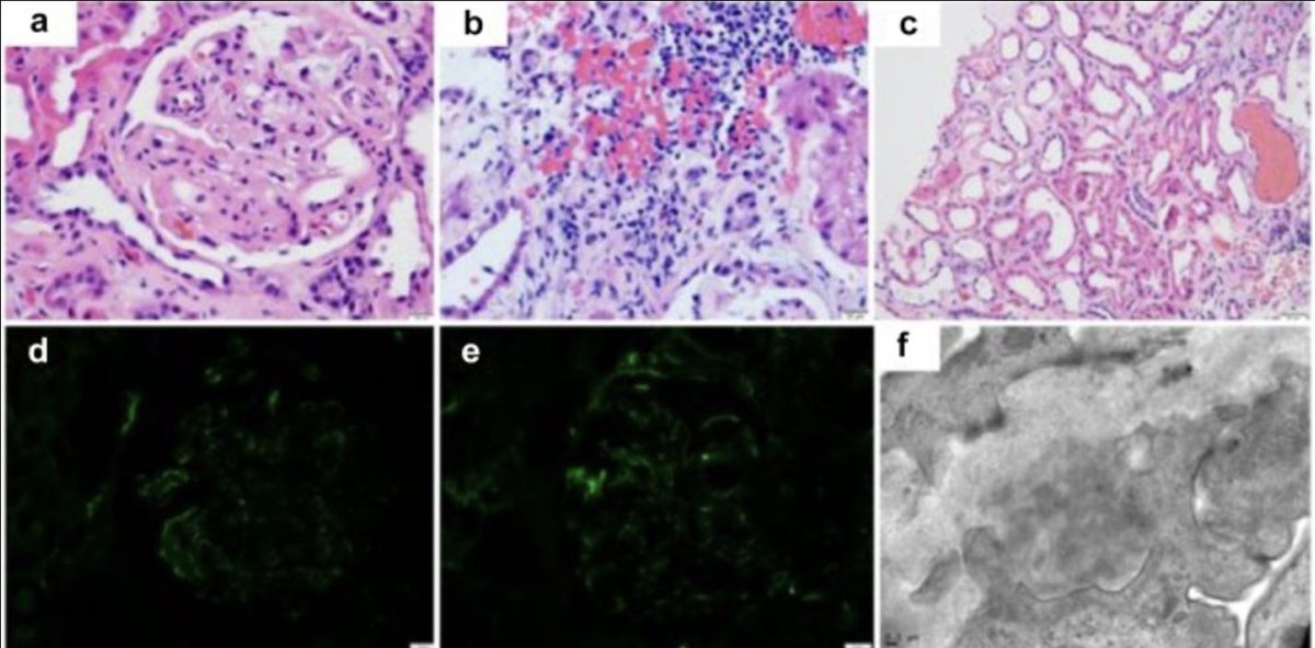 Immune Checkpoint Therapy–Induced #Lupus Nephritis doi.org/10.1016/j.ekir… #KIRNephrologyRounds