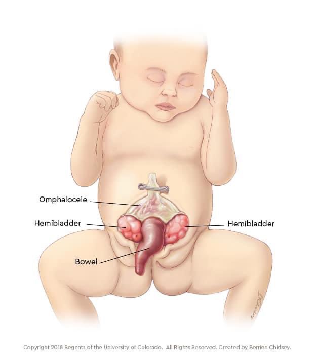 Cloacal Exstrophy in a nutshell for pediatric surgeons - a thread 🧵 
1) All bowel must be incorporated into the fecal stream and an end colostomy should be created (NOT AN ILEOSTOMY) shortly after birth. 
#SoMe4PedSurg #pedsurg