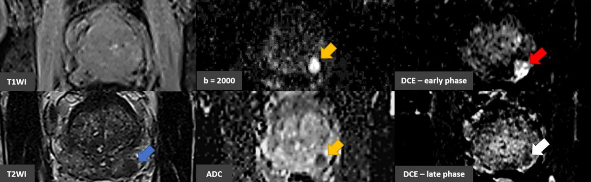Flow artifacts are frequently encountered at contrast-enhanced CT. By using the principles of fluid dynamics, radiologists can recognize how & why flow artifacts arise, distinguish them from true pathologic conditions, & use them as a diagnostic tool. bit.ly/3uuQqu1