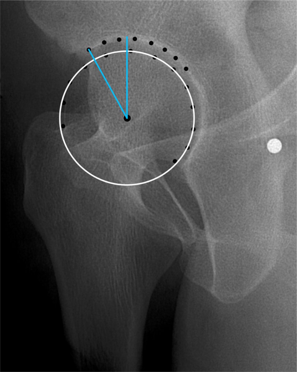 Rheum Research in Brief

Pincer Morphology Is Not Associated With Hip Osteoarthritis Unless Hip Pain Is Present: Follow-Up Data From a Prospective Cohort Study

In AC&R
loom.ly/-Y_xDGY

Figures: Measurement of the lateral center edge angle and anterior center edge angle