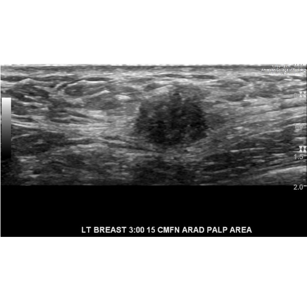 A 57-year-old African American woman with a history of hidradenitis suppurativa and prior left axillary surgery presents with a 2-week history of a palpable lump in the inner left breast. #ACRCaseinPoint bit.ly/3xUDulX