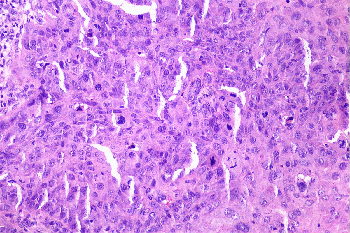 At this rate I'm already thinking about writing a series... 2 cases in less than 1 month. Tumor on the knee associated with peeling on the lower limb. IHC: HW-CK See Coment... #dermpath