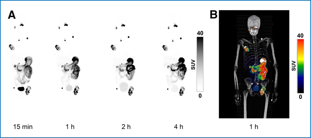 PET Agent Provides Same Day Imaging for Clear Cell Renal Cell Carcinoma Patients Learn more ➡️ bit.ly/4dJxhcL @DrMHofman @JournalofNucMed #RadOnc #RadOncEd #OncologicImaging #PETImaging #NucMed