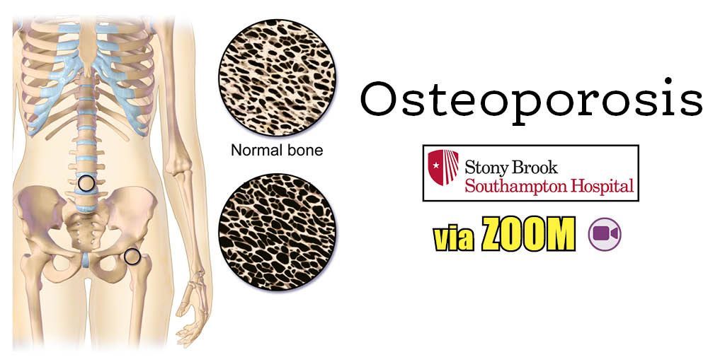 VIRTUAL ADULT HEALTH PROGRAM
Osteoporosis
Thu, May 16, 12–1PM  
Dr. Heidi Roppelt, board-certified rheumatologist at Stony Brook Southampton Hospital, will discuss osteoporosis and osteopenia, the causes, as well as diagnosis, treatment and disease management.