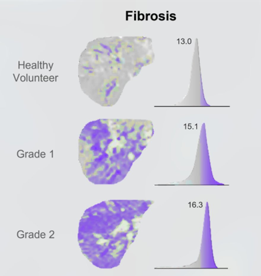 #LiverMap:  peak performance mapping #liver #fibrosis. Clear when healthy, rises with fatty liver. #MAFLD #MASLD #BodyDigital #ISMRM2024 #ISMRM