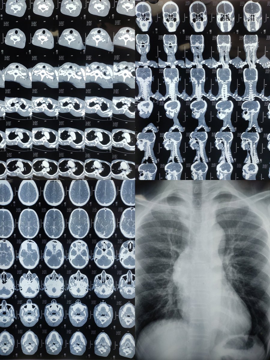 vsimemon's tweet photo. Today's case (CTVS Surgery)
A 18 year old male 
Chief complaint:- Dyspnea, fatigue on exertion×(1 year), palpitations×(6 months), NYHA-II Grade 
Diagnosed as Marfan syndrome 
No other comorbidities... 
#otawareness
🧵Thread... https://t.co/xTYWkIODjx