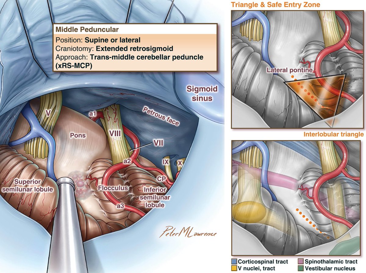 Watch the Seven Series video showing this extended retrosigmoid craniotomy, trans-middle cerebellar peduncle approach, dissection thru petrosal fissure and interlobular triangle, resection of recurrent pontine cavernoma, on our website @BarrowNeuro by clicking on this