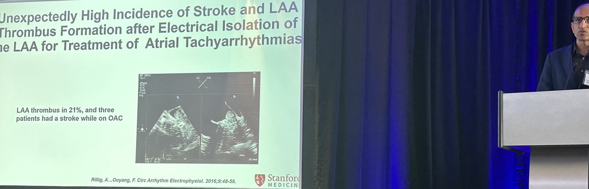 Sanjiv Narayan (@s_narayanmd) on Twitter photo <a href="/BadhwarNitish/">Nitish Badhwar</a> #LAAO left atrial appendage occlusion/isolation effective, with ⬇️ P wave dispersion, improved autonomics, but don’t forget risks eg thrombus. #AI may personalize responders. <a href="/DJ_Lakkireddy/">DJ Lakkireddy</a> <a href="/VivekReddyMD/">Vivek Y. Reddy</a> @MiguelVldrbno #Stanford2024 <a href="/BadhwarNitish/">Nitish Badhwar</a> #LAAO left atrial appendage occlusion/isolation effective, with ⬇️ P wave dispersion, improved autonomics, but don’t forget risks eg thrombus. #AI may personalize responders. <a href="/DJ_Lakkireddy/">DJ Lakkireddy</a> <a href="/VivekReddyMD/">Vivek Y. Reddy</a> @MiguelVldrbno #Stanford2024