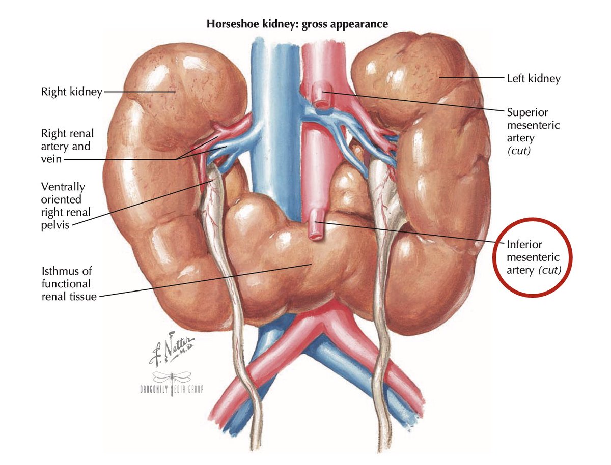 Miércoles de #UroTips 💡🤓 ✅En el riñón en herradura, el ascenso embriológico (normal) del riñón es limitado por la presencia de ➡️ La Arteria Mesentérica Inferior. #SoMe4PedSurg #PedsUro #UroSoMe #FlashCards #HorseShoeKidney #MedX