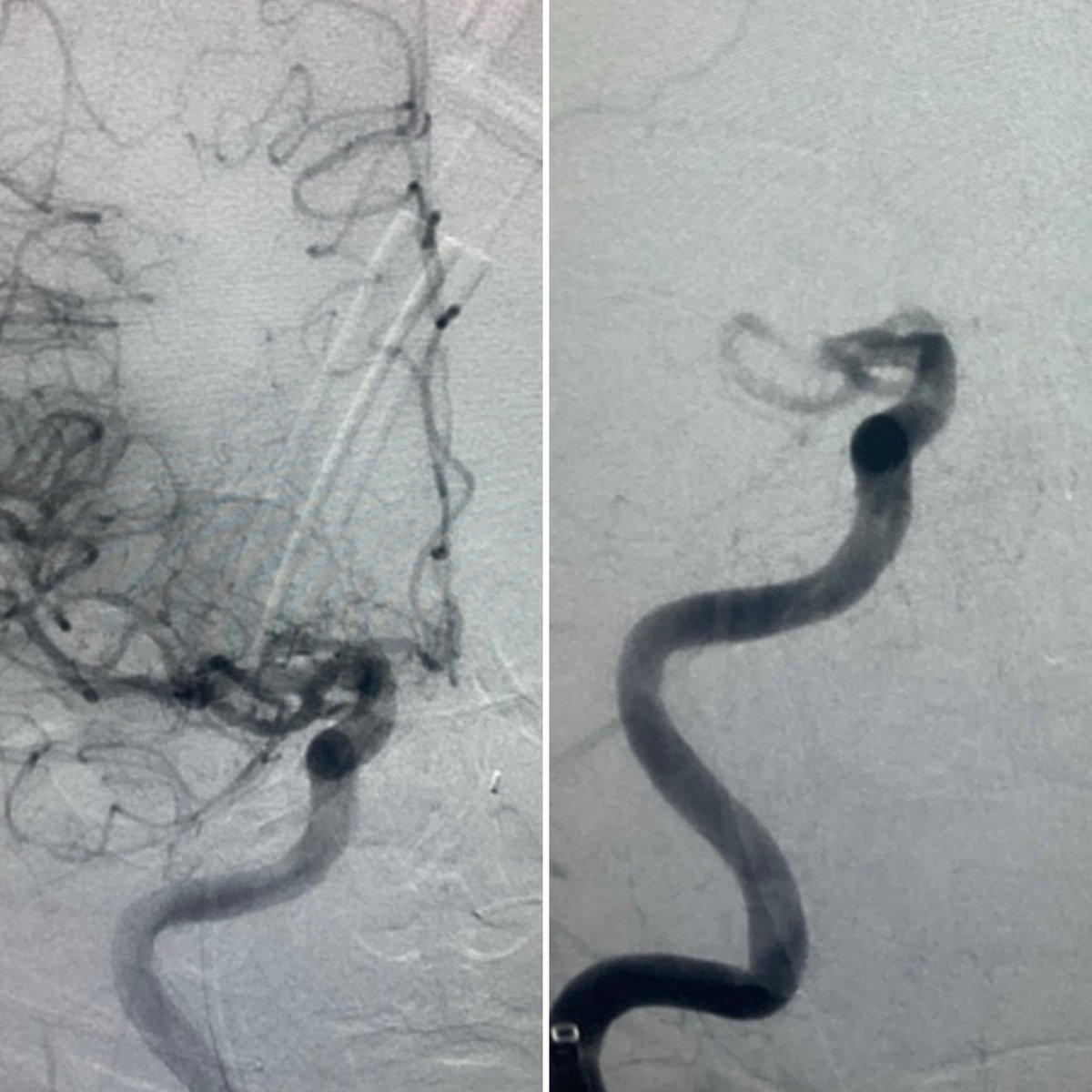 evanluthermd's tweet image. 4 strokes in 4 days. Basilar occlusion, ICAD, ICAt, + tandem occlusion. Lucky to train @StrokeMiami @UMneurosurgery @JacksonHealth Especially thankful to my junior fellow Luis Guada MD. All gas, no brakes ⛽️ Been an exceptional year. #stroke #endovascular #neurosurgery #youngNIR