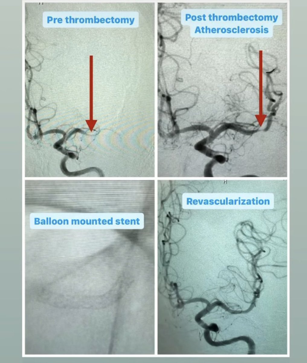 evanluthermd's tweet image. 4 strokes in 4 days. Basilar occlusion, ICAD, ICAt, + tandem occlusion. Lucky to train @StrokeMiami @UMneurosurgery @JacksonHealth Especially thankful to my junior fellow Luis Guada MD. All gas, no brakes ⛽️ Been an exceptional year. #stroke #endovascular #neurosurgery #youngNIR