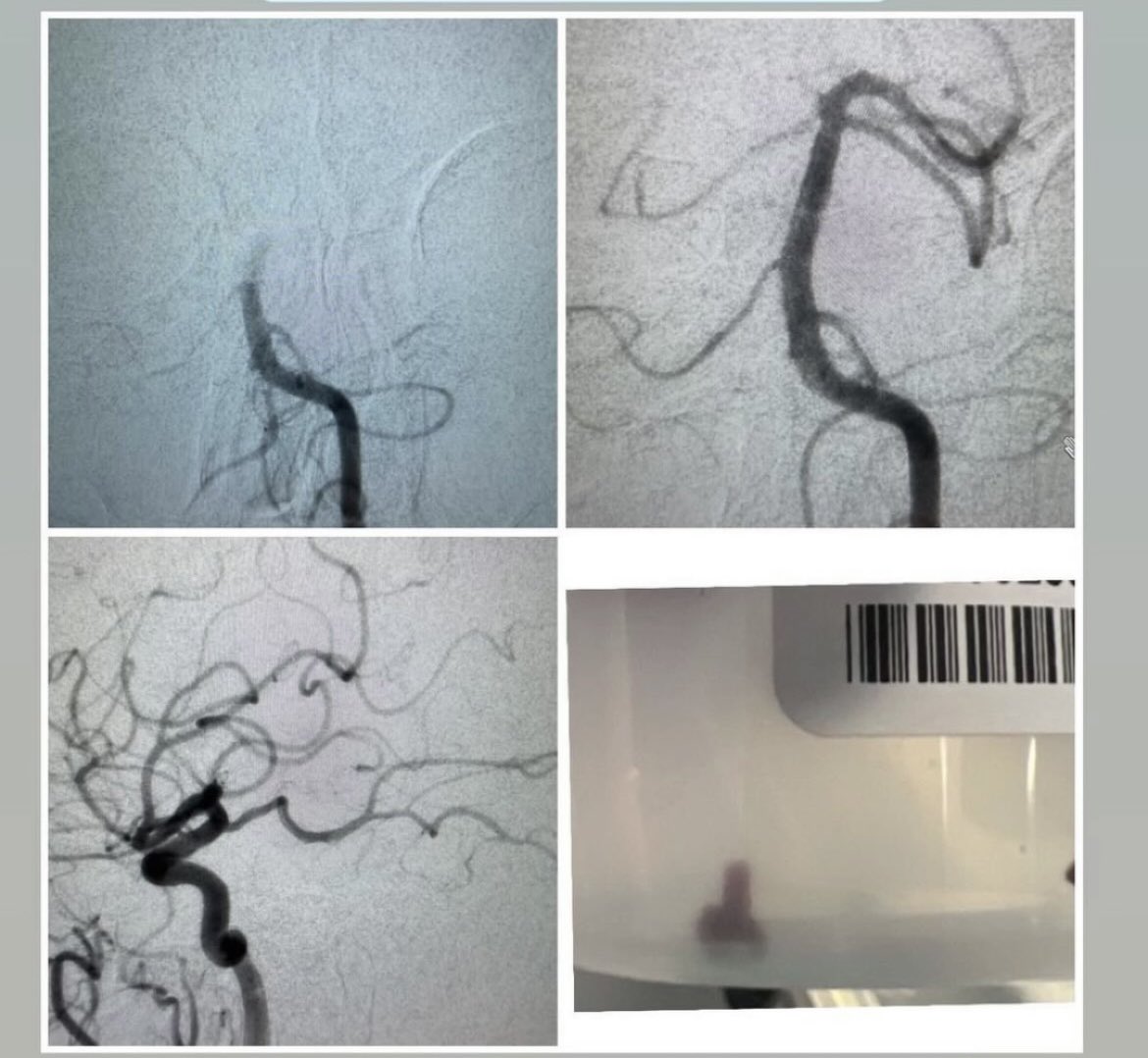 evanluthermd's tweet image. 4 strokes in 4 days. Basilar occlusion, ICAD, ICAt, + tandem occlusion. Lucky to train @StrokeMiami @UMneurosurgery @JacksonHealth Especially thankful to my junior fellow Luis Guada MD. All gas, no brakes ⛽️ Been an exceptional year. #stroke #endovascular #neurosurgery #youngNIR