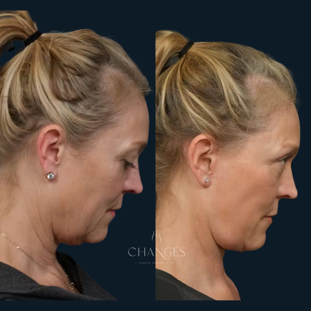 ChangesPlastic's tweet photo. Witness the power of transformation! Here's what she received to reach her aesthetic goals:

Changes Rapid Lift
Neck Lift
Lower Blepharoplasty
Fat Grafting
Topical RF
Corset Platysmaplasty
TCA peel

Her glow is undeniable. 🌟 Ready for results of your own? Book at the link below. https://t.co/JfNcVpag3g