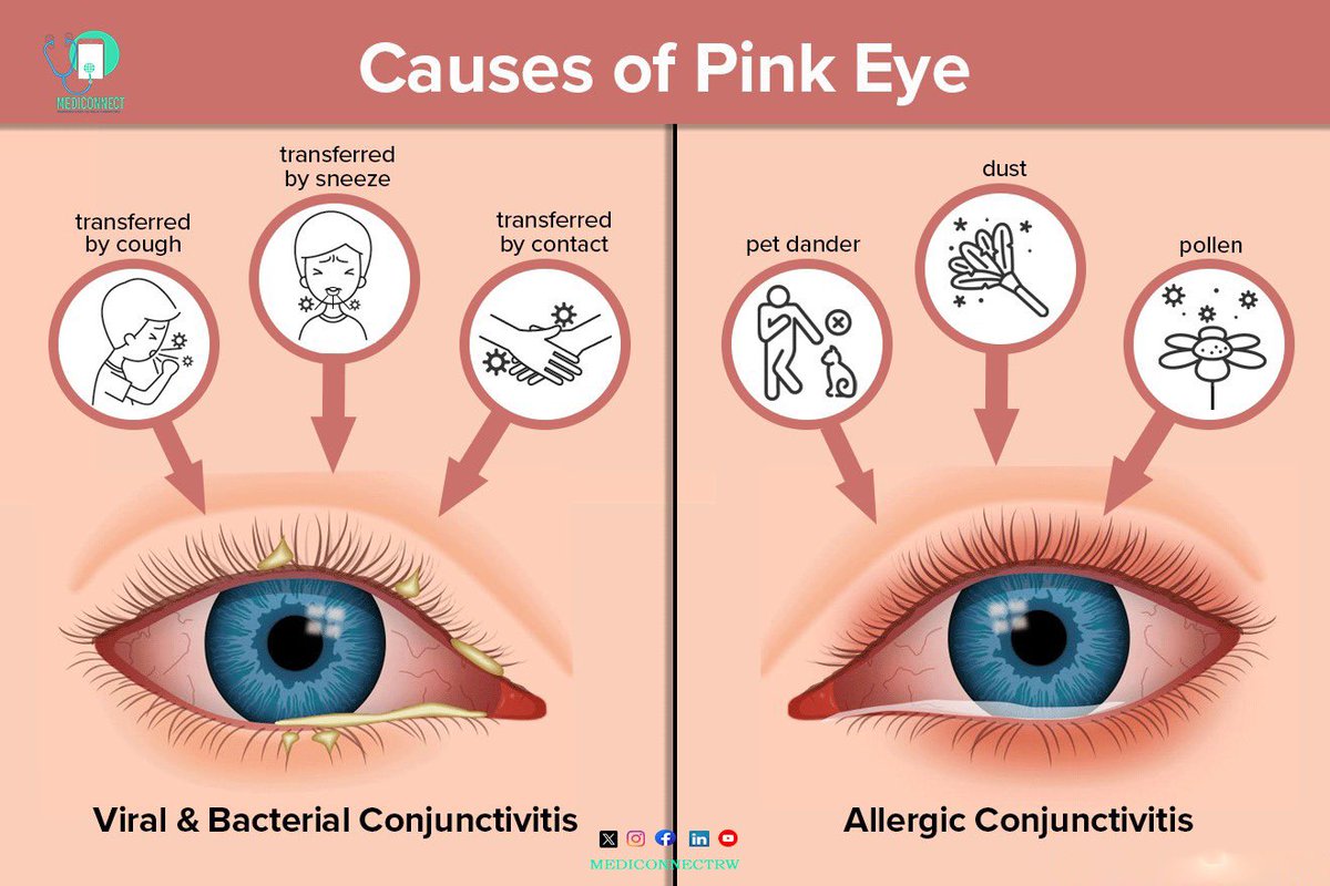 mediconnectrw's tweet photo. Pink eye alert! 🚨 Prevention tips: Wash hands frequently, avoid touching your face, don't share towels or makeup, and clean contact lenses properly. If symptoms appear, seek medical advice and avoid spreading it to others. #PinkEyePrevention #EyeHealth" https://t.co/YgFUTneI0X