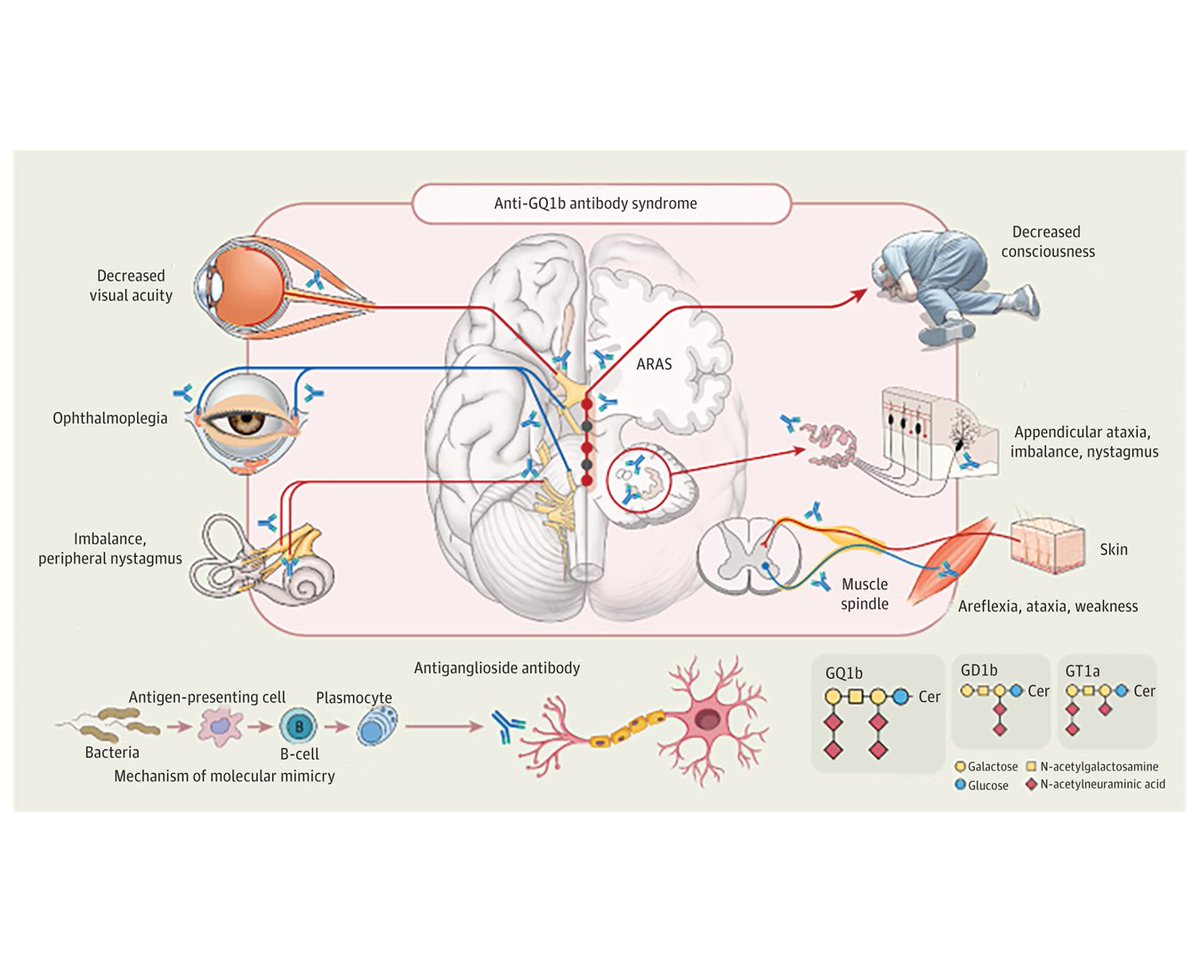 The clinical spectrum of anti-GQ1b antibody syndrome continues to expand to include acute vestibular syndrome, optic neuropathy, and acute sensory ataxic neuropathy in addition to classic syndromes. ja.ma/4dOAfNo #MFS #GQ1b #Ophthalmoplegia