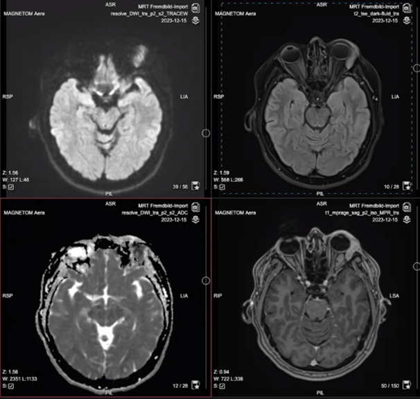 First MDT Case: Left lacrimal gland lesion