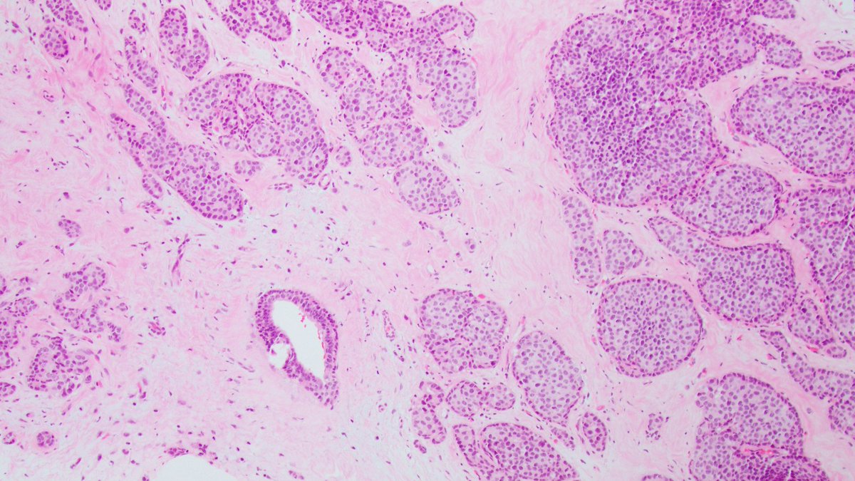 Do not mistake peripheral palisading in invasive carcinoma for a preserved myoepithelial layer. Invasive solid papillary carcinoma with peripheral palisading (pseudo-myoepithelial layer). @wusm_pathology @washupathedu #breastpath #PathTwitter #PathX