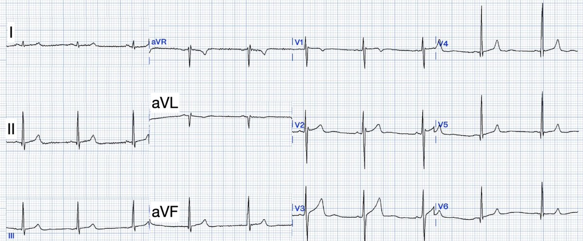 Crushing Chest Pain and Can't see OMI on the ECG? Just give morphine, right? hqmeded-ecg.blogspot.com/2024/05/crushi… @willyhfrick