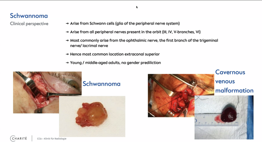 MDT 2nd Case: Schwannoma - important to distinguish from cavernous venous malformation Katharina Erb-Eigner & Eckart Bertelmann& Lynn Sophie zur Bonsen, Berlin/DE