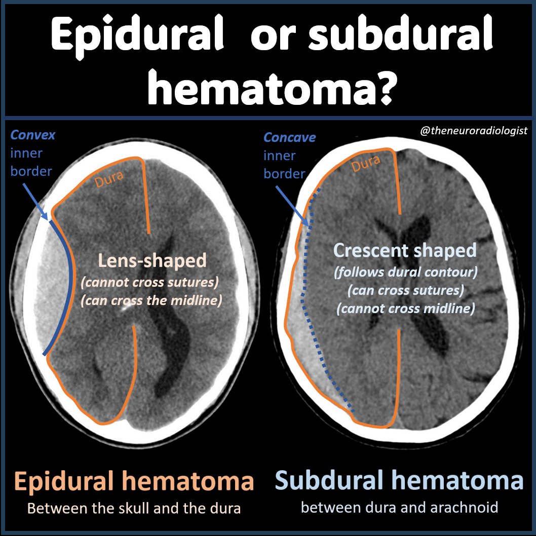 Back to the basics: how to tell epi- from subdural hematomas on imaging? Part of a new video on imaging of traumatic brain injury which can be found here: youtube.com/watch?v=uQdiKG…

#neurorad #radres #FOAMed #MedEd #FOAMrad #RADed #radiology #brain