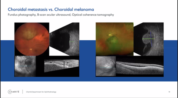 The last MDT Case: Ocular lesion -don't forget about choroidal metastasis Katharina Erb-Eigner & Eckart Bertelmann& Lynn Sophie zur Bonsen, Berlin/DE