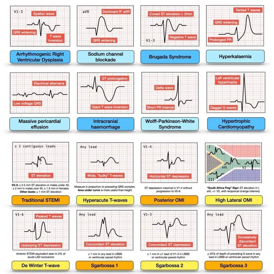 🔴🔑 ECG patterns to remember : 16 important ECG patterns that should not be missed. #ACCFIT #CardioX (via Jason Winter: ECG educator illustrator page, UK) #cardiotwiteros #medical #meded #medtwitter #CardioTwitter #cardiology #CardioEd #Cardiox