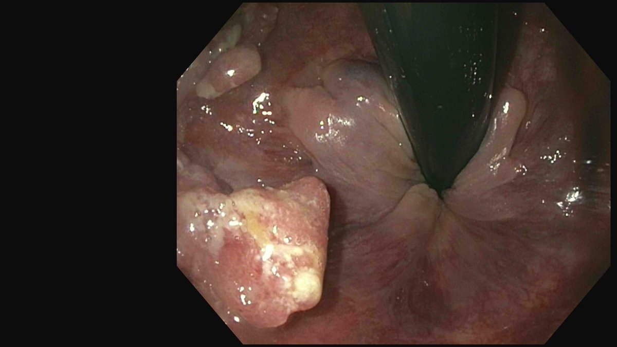A very low lying rectal cancer. Close to, but not involving, the dentate line. #gitwitter #surgery #medtwitter