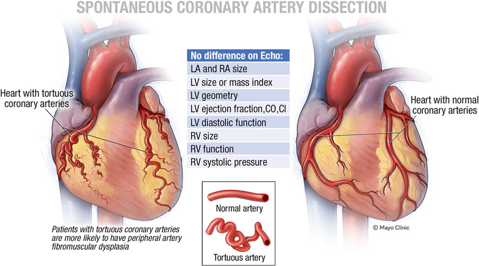 The etiology & significance of coronary artery tortuosity among patients with spontaneous coronary artery dissection are unknown. The aim of this study was to evaluate whether TCA correlates with cardiac anatomy & function among patients with SCAD. bit.ly/4bFz4Oo