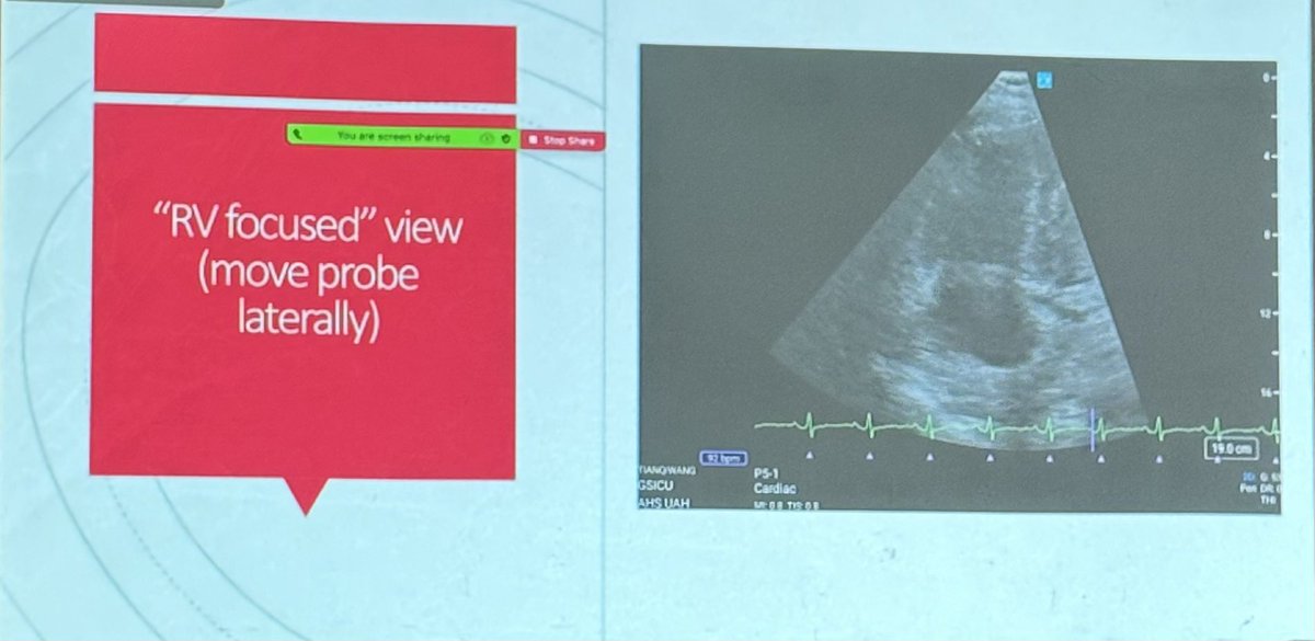 Dr Peter Wang, GIM Senior Resident and POCUS fellow, UofC, reviewing assessment of RV size and function at Canadian Acute Care US Rounds. @IM_POCUS #POCUS