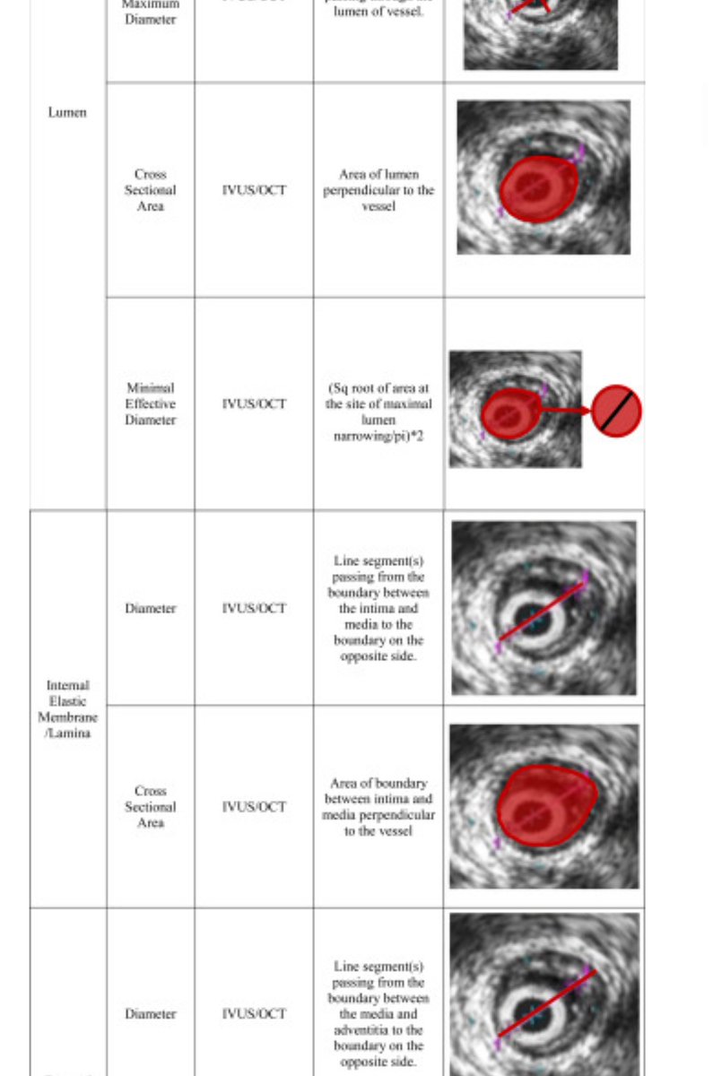 We all talk about the importance of IVUS sizing but HOW do you size? Cross section? IEL to IEL? “Effective” diameter? Are you sizing up? Are you consistent? Our paper explores vessel sizing @AmputationSuck @EricSecemskyMD @AlanLumsdenMD jvsvi.org/article/S2949-…