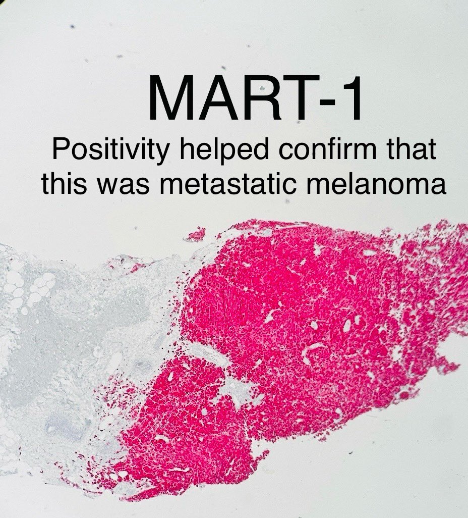 Melanoma: The Great Mimicker • I feel like for cancer of unknown origin, there has never been a wrong time to say melanoma as your differential diagnosis • Breast biopsy 👇 Image Credit: Michelle Josey, MD #pathagonia #path4people #pathx #pathtwitter #derm #breastpath
