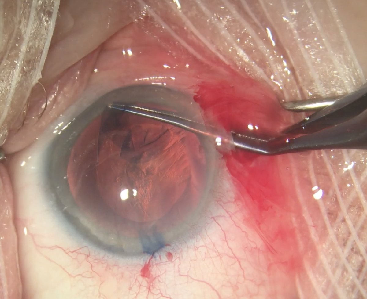 Post-cataract IOP Spike is Significant Predictor of Spike in Fellow Eye Patients were more likely to experience another incident even after accounting for other risk factors, according to an ARVO abstract. reviewofoptometry.com/news/article/p… #cataract #optometry #ARVO #ARVO2024