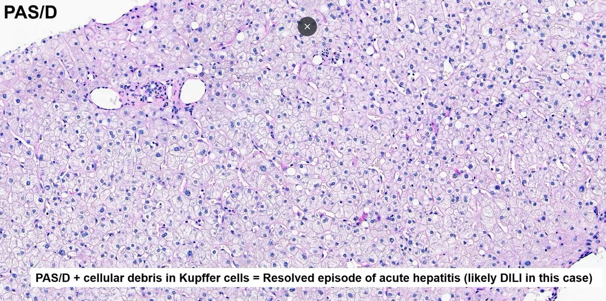 #Everydayliver 55yo female with fatigue, mildly elevated liver chemistry tests, other tests are negative Medications: Atorvastatin, hydroclorothiazide, Gingko biloba, ginseng, tumaric, vitamins 🔬H-E completely normal except these👇almost invisible ceroid laden Kupffer cells.