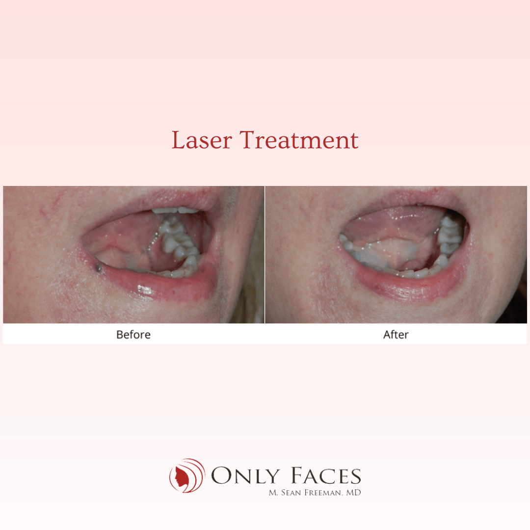 OnlyFacesCLT's tweet photo. This patient received Pulsed dye #laser and Nd:YAG treatment for Venous Lake. #LaserTreatment #OnlyFaces https://t.co/08qjOrFiCD