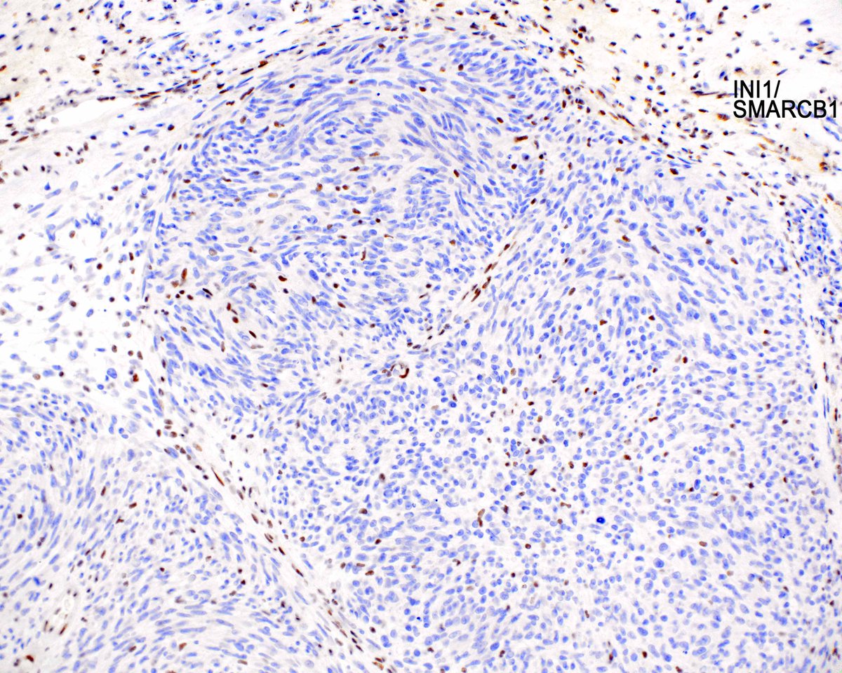 This epithelioid malignant peripheral nerve sheath tumor shows loss of INI1/SMARCB1, a feature of this type of neoplasm. innovativesciencepress.com