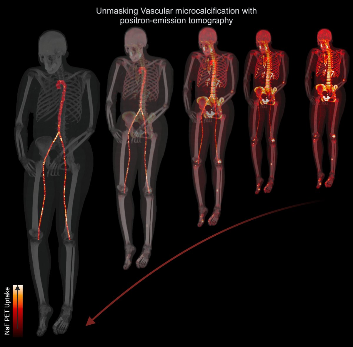 #PETscan technique developed by @NIDCR & @NIHClinicalCntr allows researchers to monitor calcium buildup in the arteries of patients with a genetic #raredisease that causes abnormal deposits of phosphate & calcium in the body. ahajournals.org/doi/epdf/10.11… @atvbahajournals