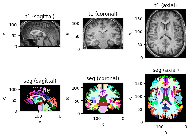 You can now slice TorchIO images and subjects!

>>> import torchio as tio
>>> subject = tio.datasets.FPG()
>>> subject[50:200, 50:-30].plot()

The image origin in the spatial metatada is updated accordingly as the Crop transform is used under the hood.

(orientation here is PIR+)