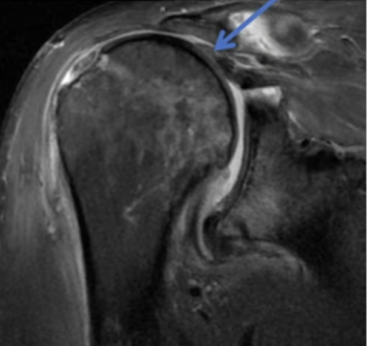 How shoulder we treat massive irreparable cuff tears? shoulderarthritis.blogspot.com/2024/05/how-sh…