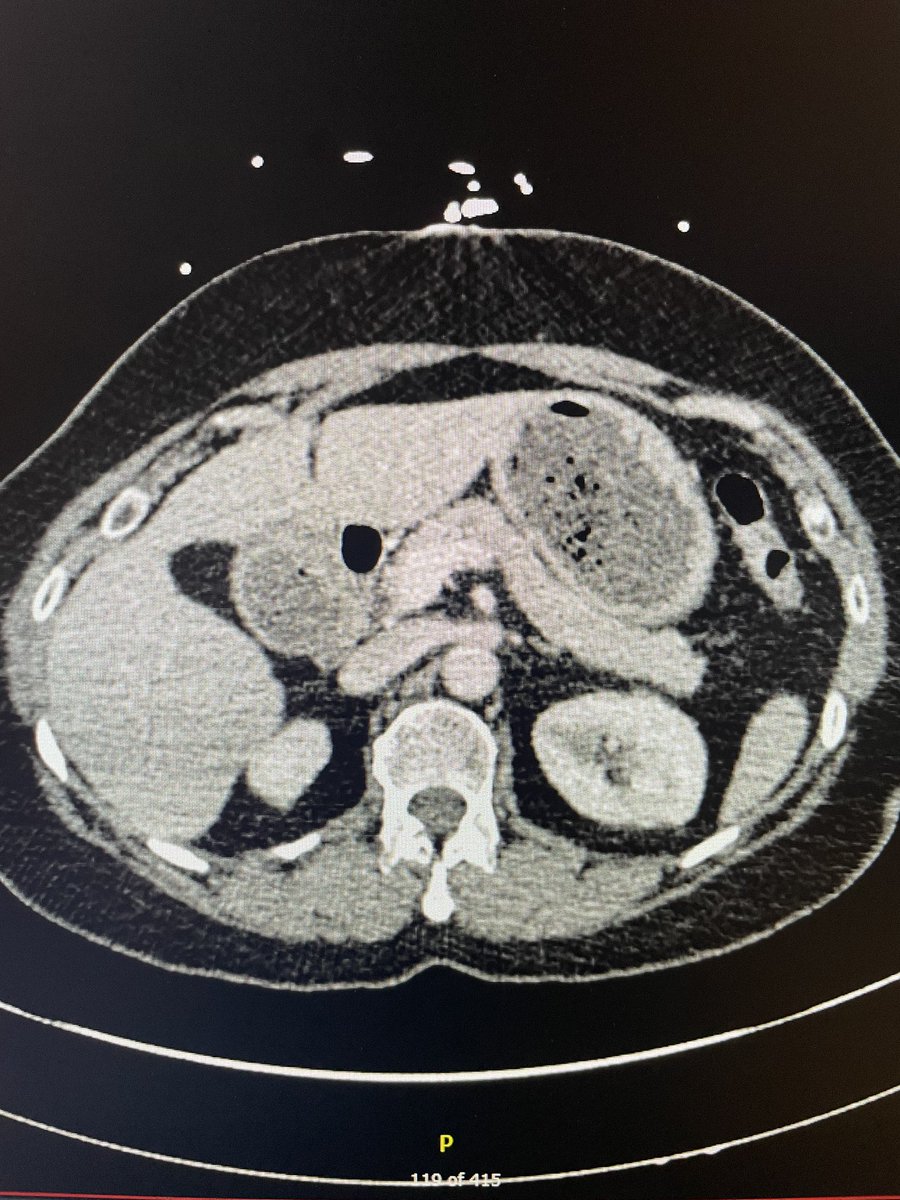 Autoimmune pancreatitis, pre-and post treatment with corticosteroids #gitwitter #pancreas #medtwitter