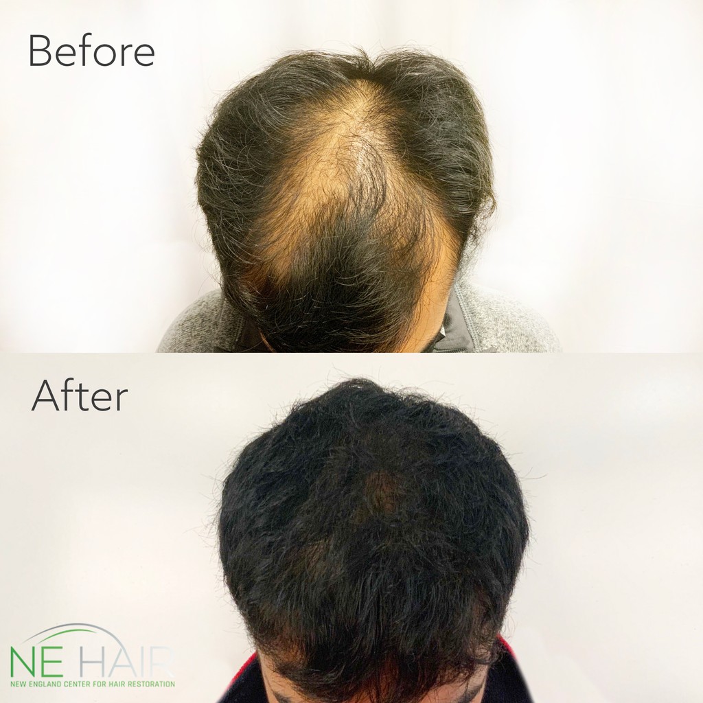 The Power of microFUE™️⁠

#microfue #fuehairtransplant #hairtransformation #hairtransplantUSA #hairtransplantboston #hairline #hairsurgery #womensshairloss #thinninghair #hairlosssolution #hairrestoration #hairreplacement #selfcare #medspa #boston #fue