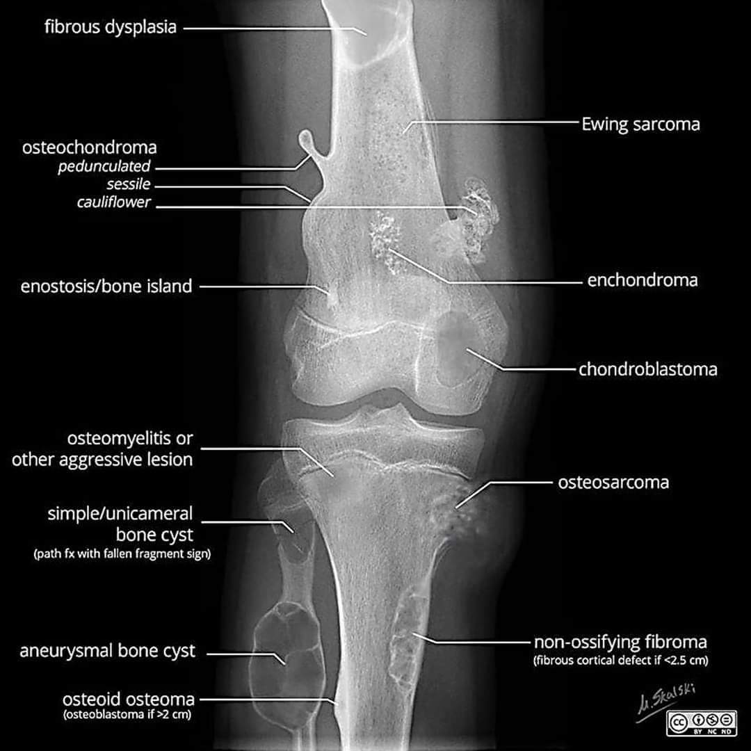 آفات العظام الشائعة في صورة واحدة☢️
Common bone lesions in one image 🫡