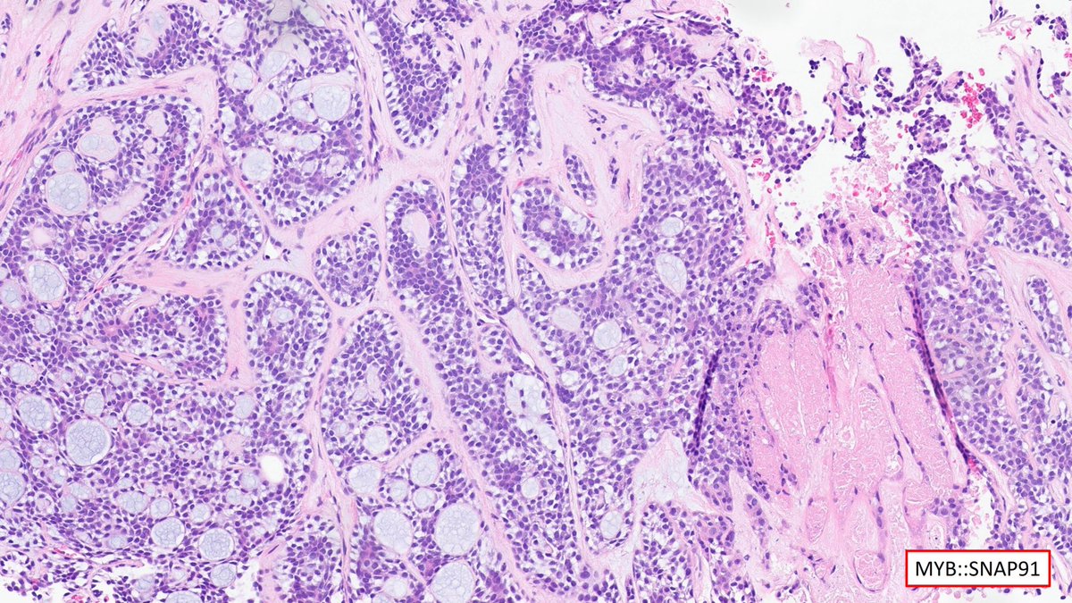 Adenoid cystic carcinoma with prominent cytoplasmic clearing. 

Unusual fusion: MYB::SNAP91

#pathology #pathologist #headandneck #PathTwitter #oralpath #ENT #ENT_Pathology #headandneckpathology